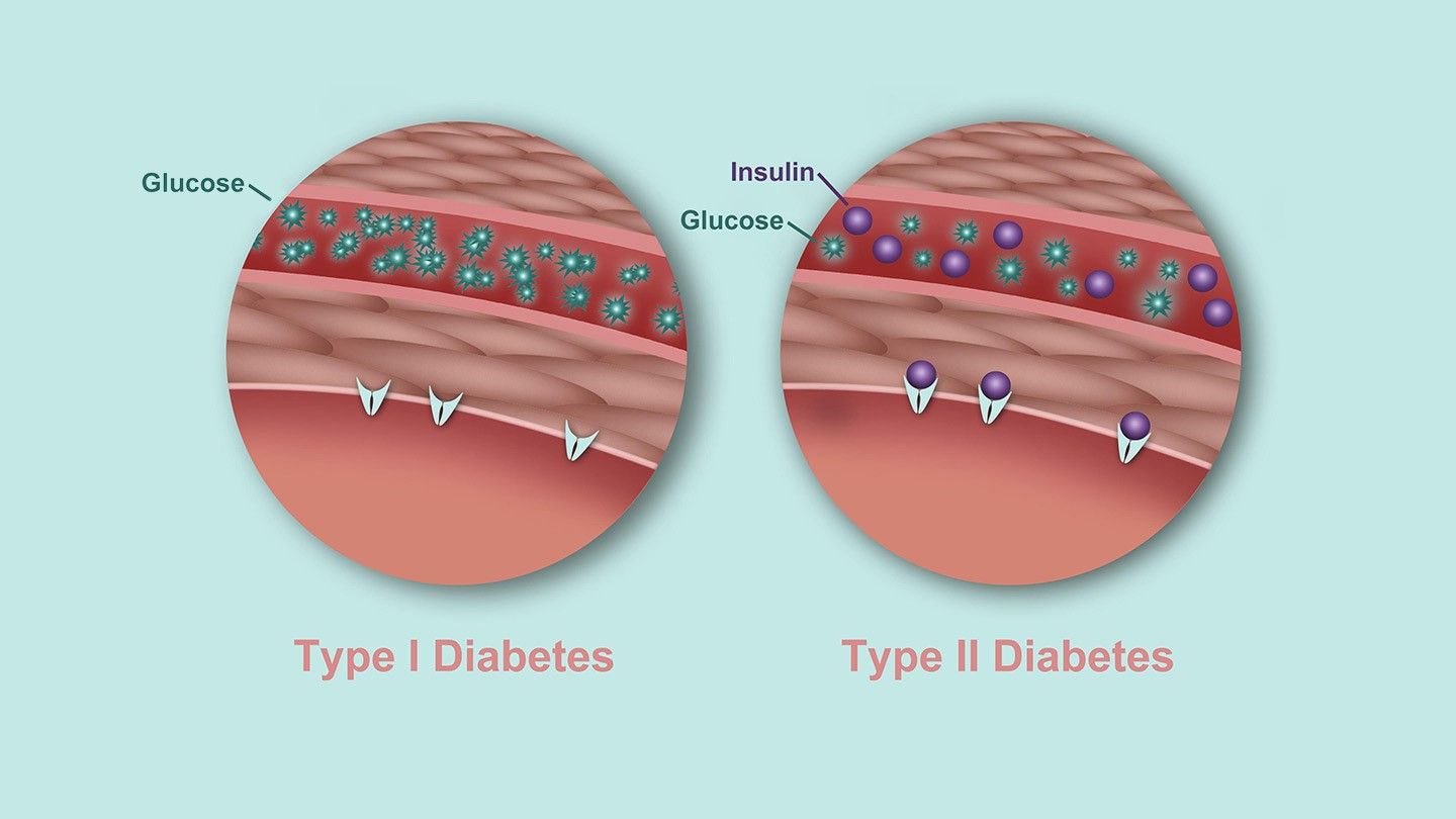 whats the difference between type 1 and type 2 diabetes rm 1440x810 1 Post