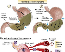 Understanding Diabetic Gastroparesis: Symptoms and Treatment Options