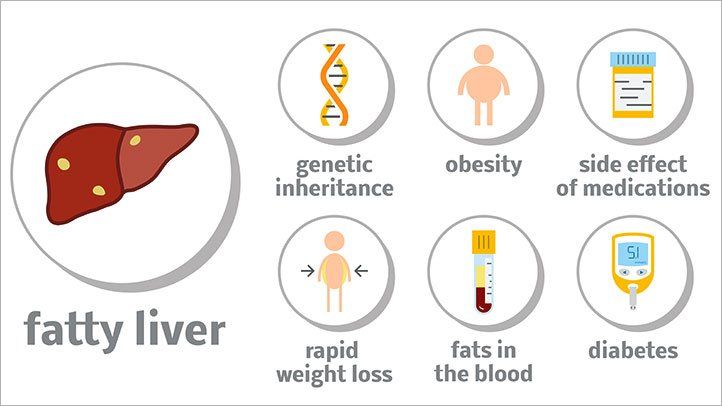 what is nonalcoholic fatty liver disease 722x406 1 Post